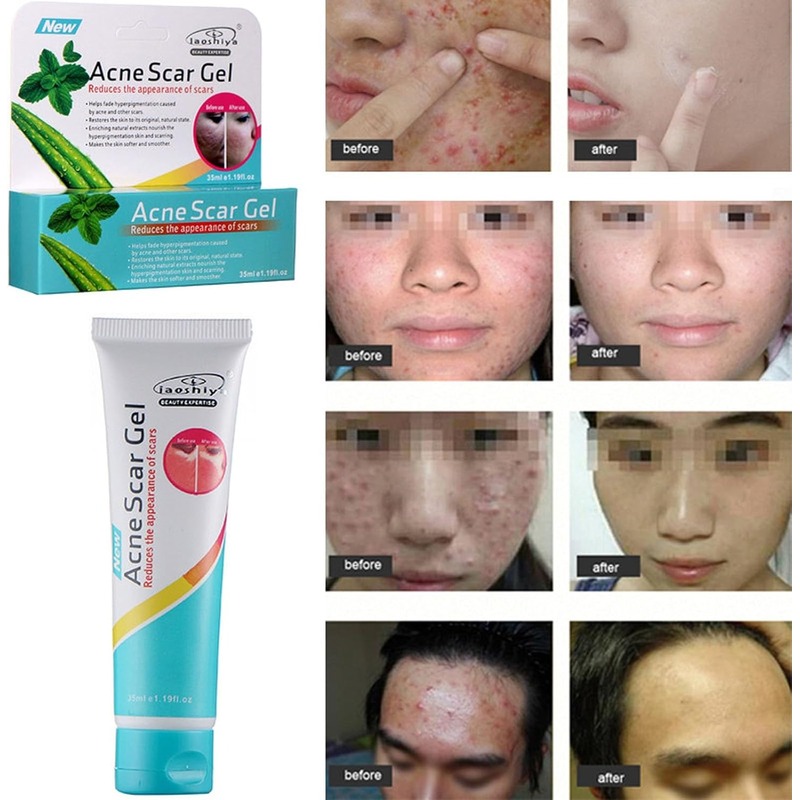 Laoshiya Acne Scar Gel