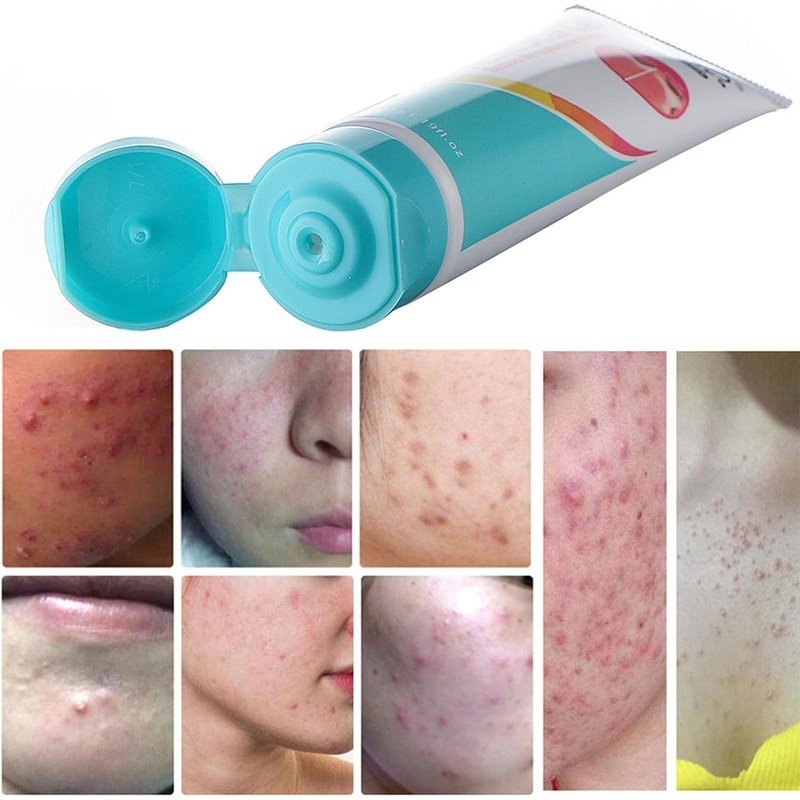 Laoshiya Acne Scar Gel